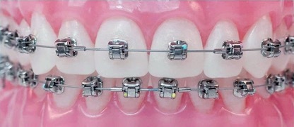 Jak wybrać irygator do aparatów ortodontycznych: przegląd głównych wymagań - Setafi